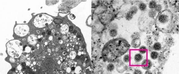 На левой части изображения - повреждение клеток с набухшими везикулами
