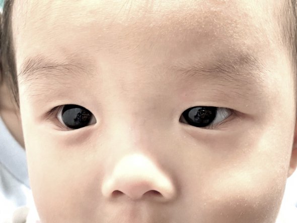 Препарат от COVID-19 дал побочный необычный эффект: у младенца карие глаза стали цвета индиго