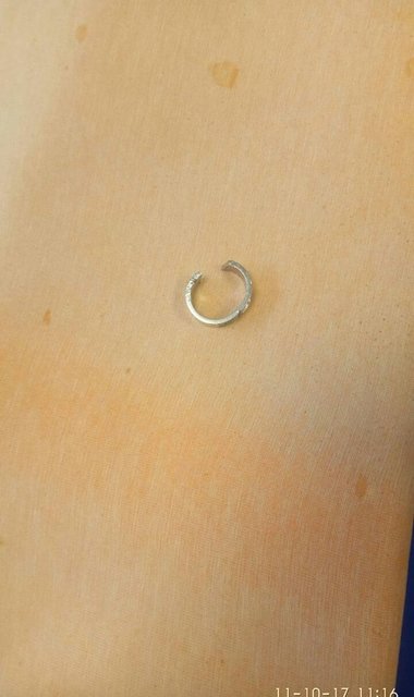 Палець дівчини розпух, вона не змогла зняти каблучку