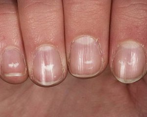 Чому на нігтях з’являються білі плями