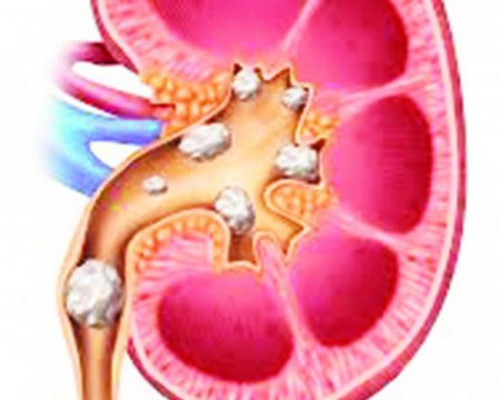 Як вивести камені з нирок господарюванням українською мовою Як позбутися каменів у нирках