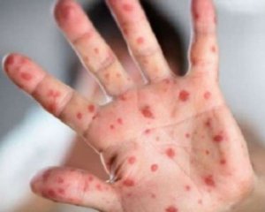 Щеплення від кору відтепер безкоштовне для дорослих будь-якого віку - МОЗ
